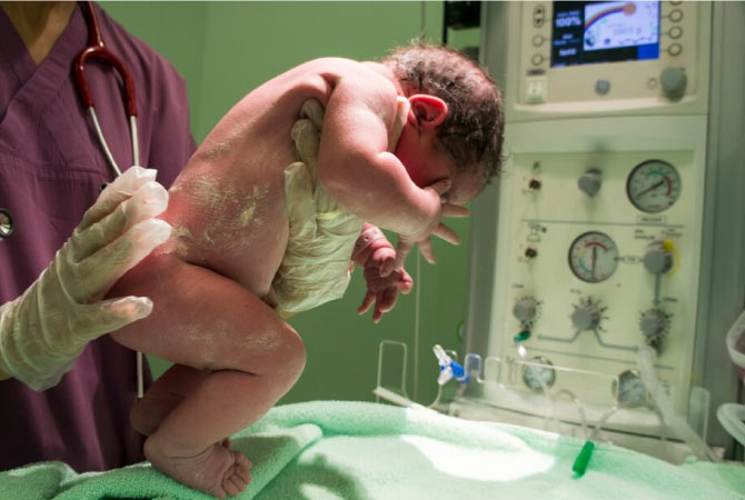 Neonatal Care In Bangalore - Ovum Hospitals