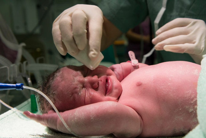 Neonatalogists Care For Newborns - Ovum Hospitals