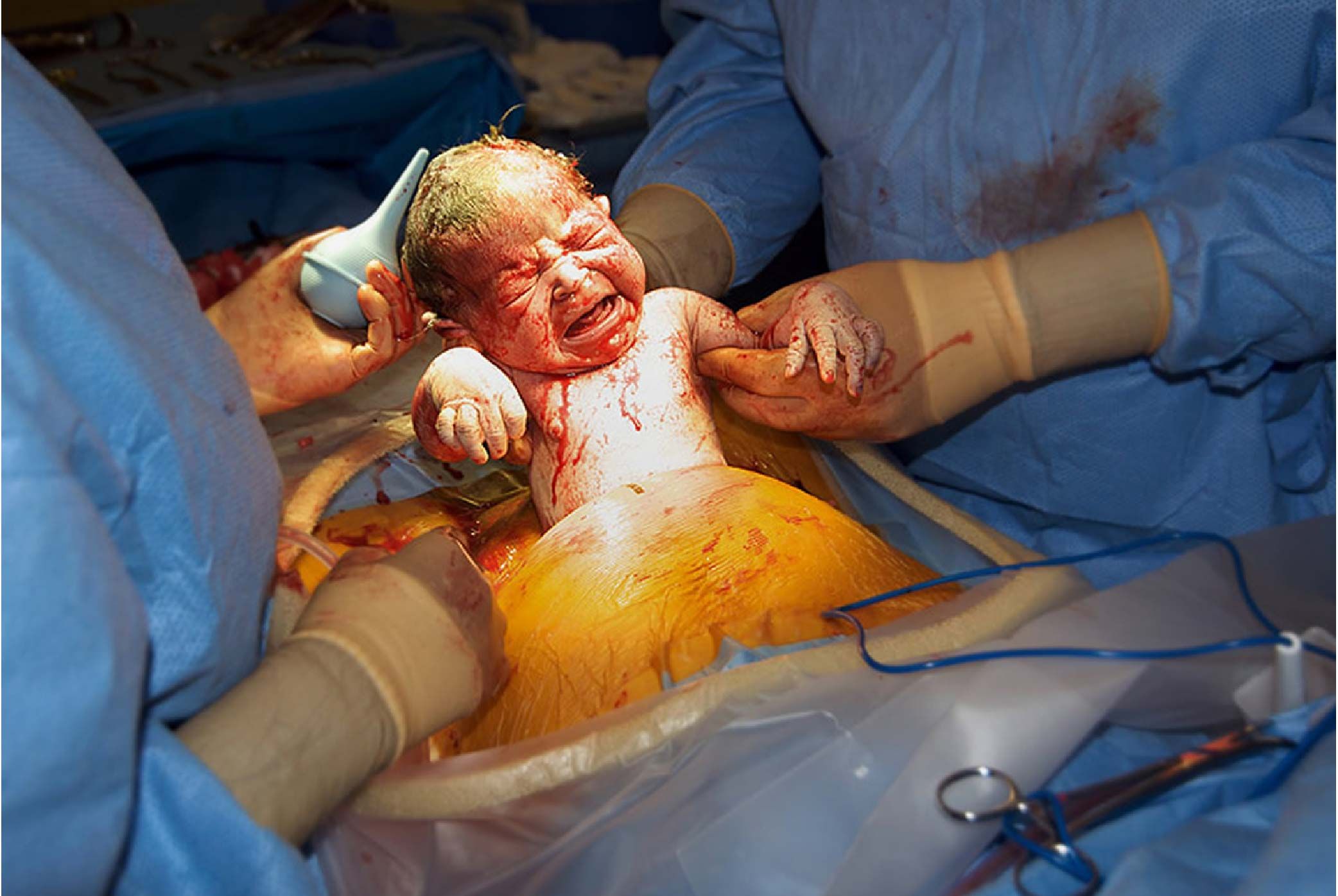 Cesarean sections: what you need to know