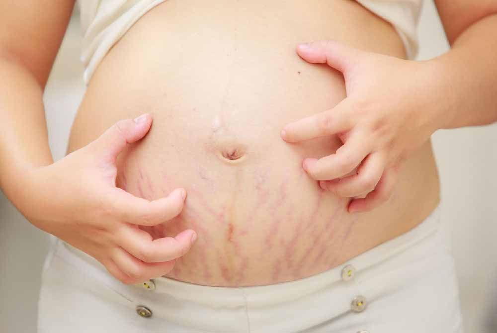 Coping with pregnancy-related itching: Causes and remedies