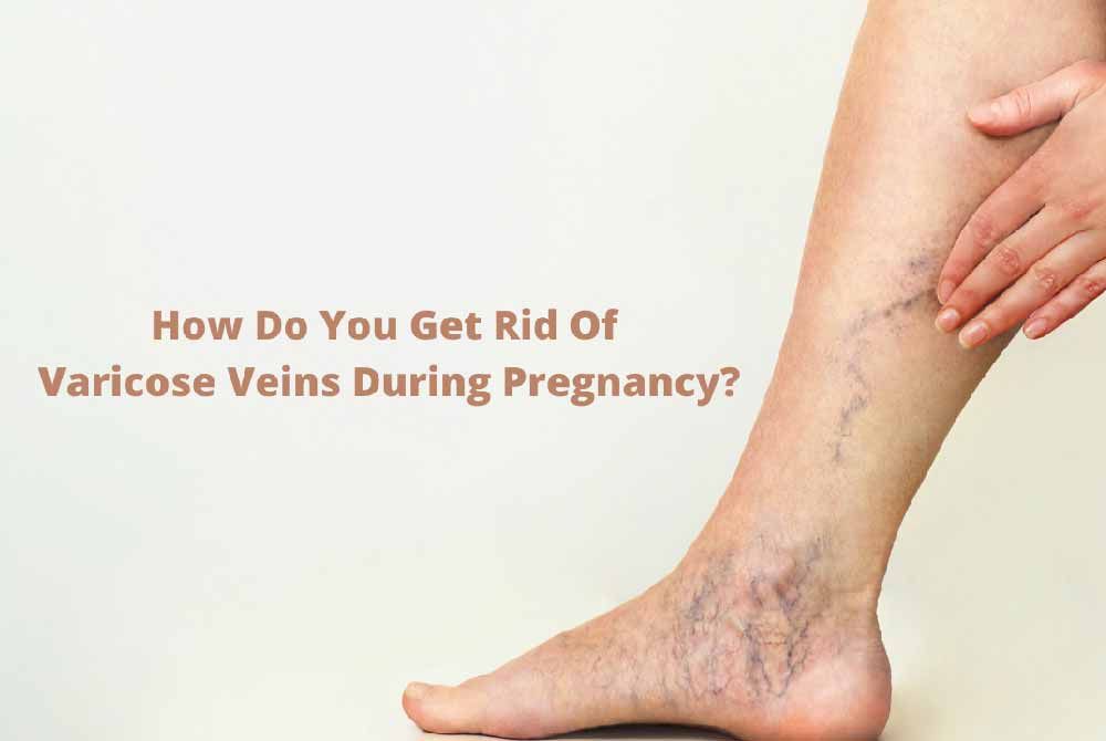 Coping with pregnancy-related varicose veins: Prevention and treatment.