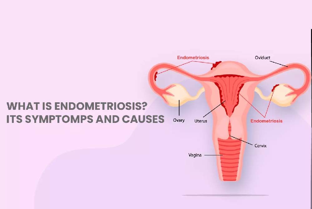 Endometriosis and period pain: Understanding the connection