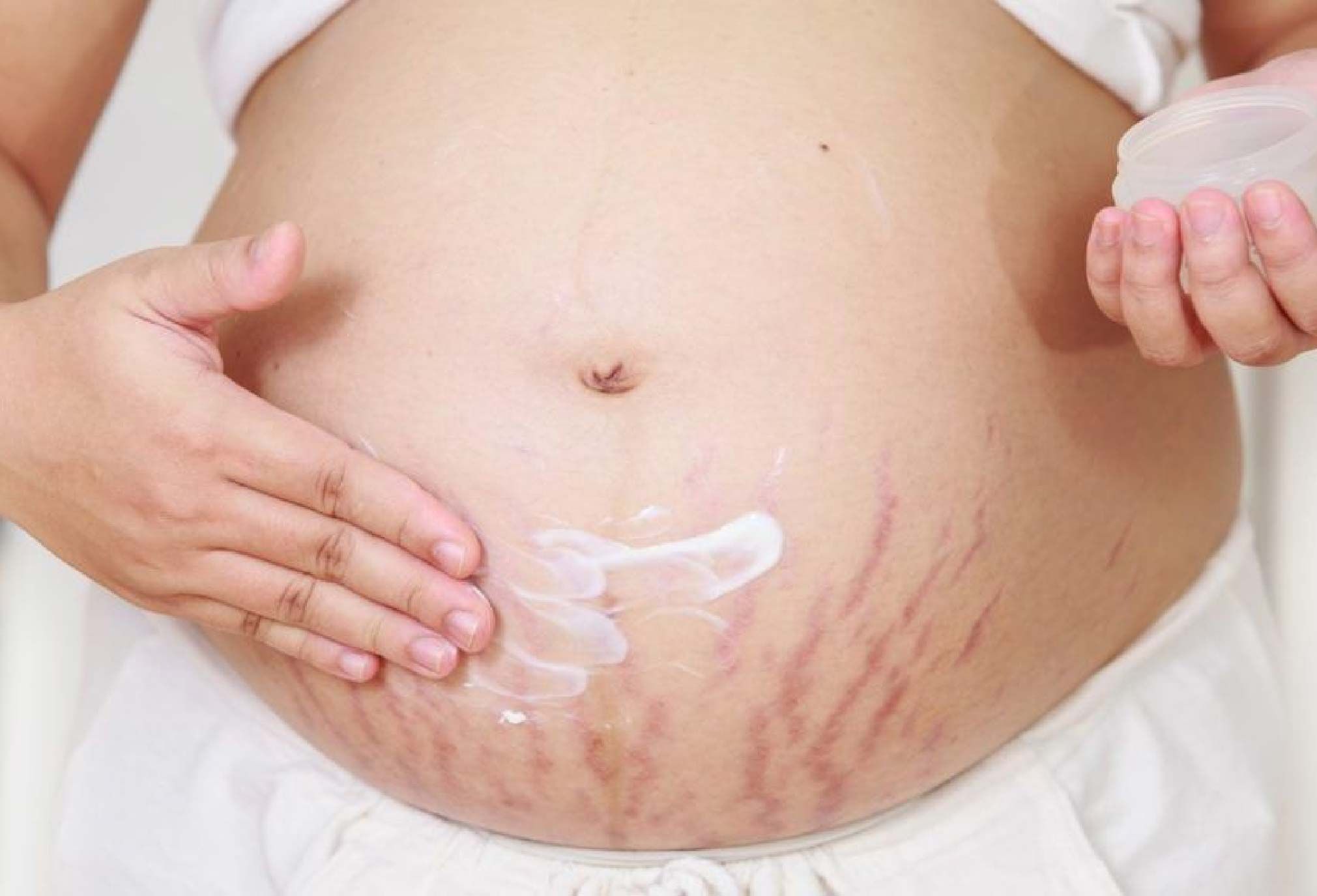 How can I prevent stretch marks?