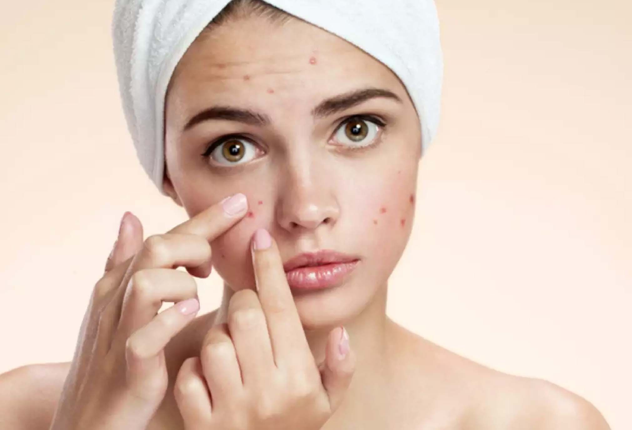 How to Handle Teen Acne