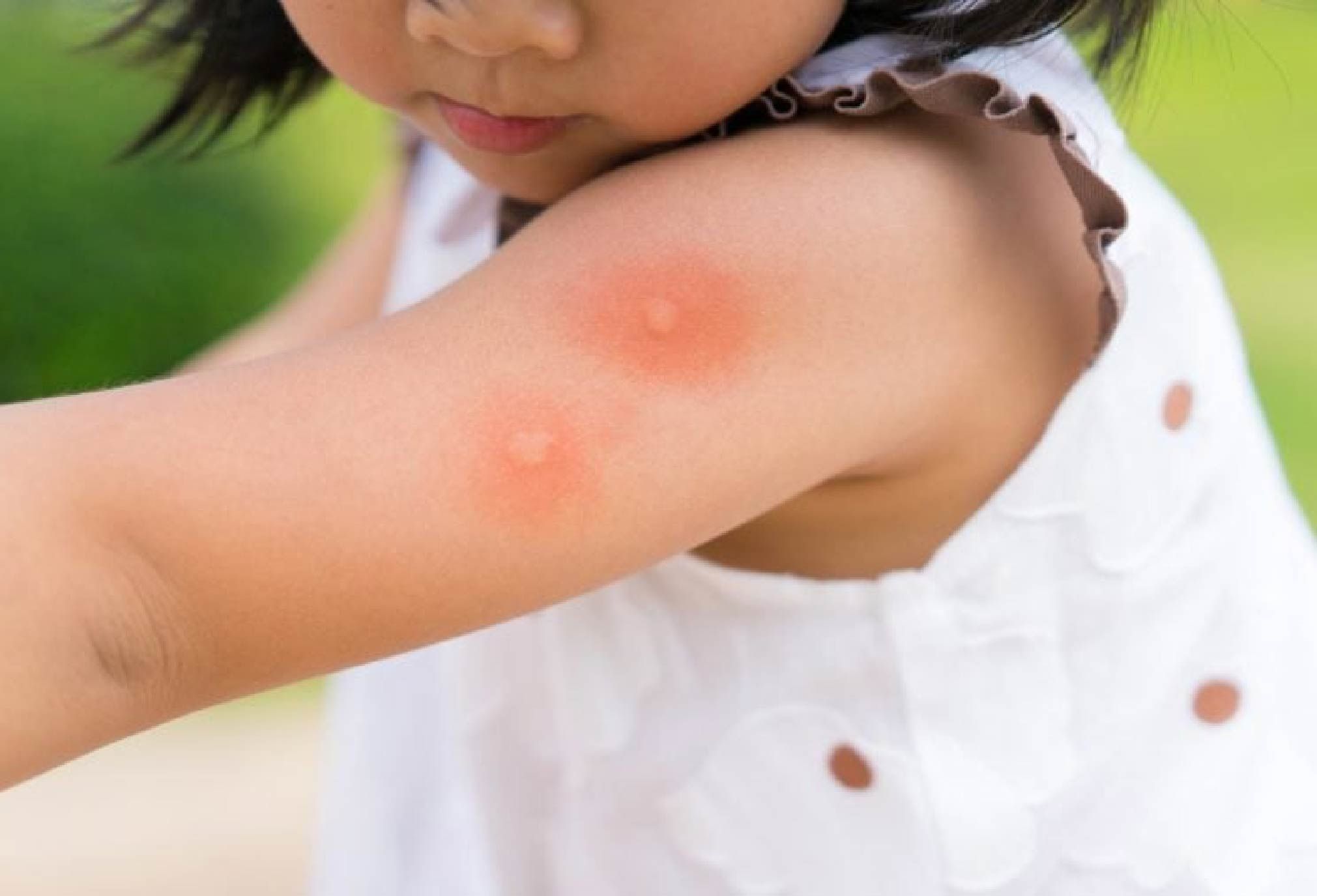 How to handle insect bite