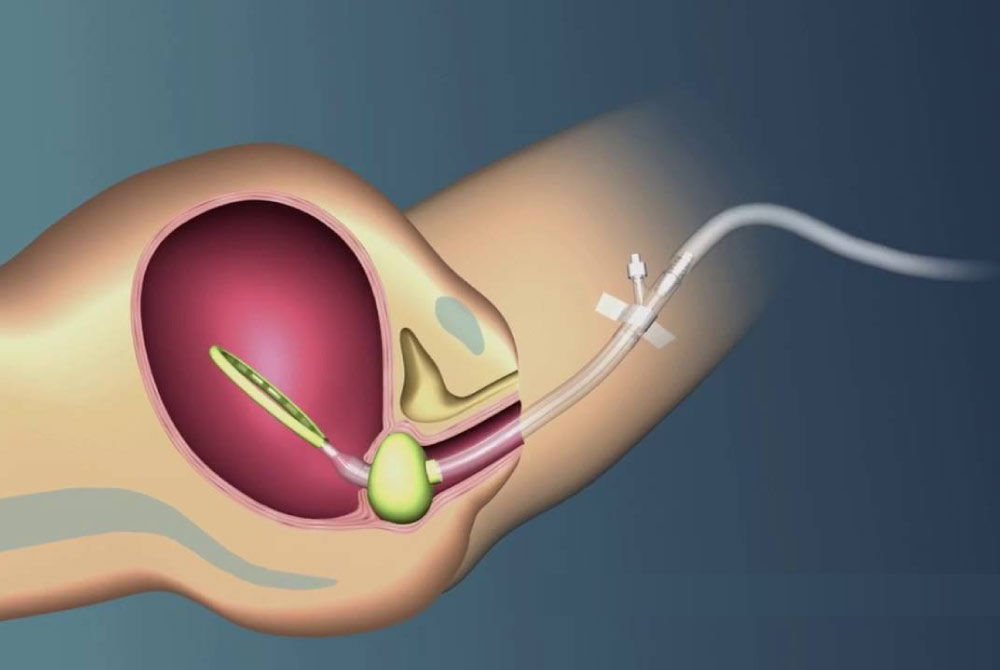 Intrauterine Postpartum Hemorrhage-Control Devices