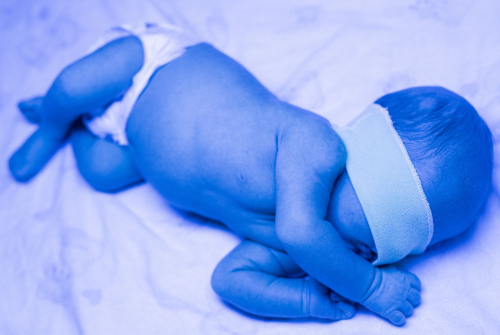 Neonatal Jaundice: Causes, Symptoms, and Treatment Options