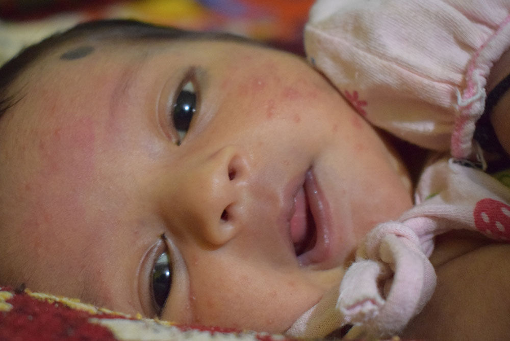 Newborn Rashes