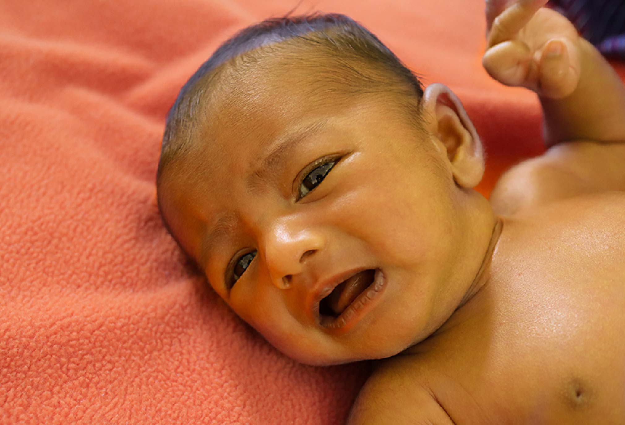 Newborn jaundice
