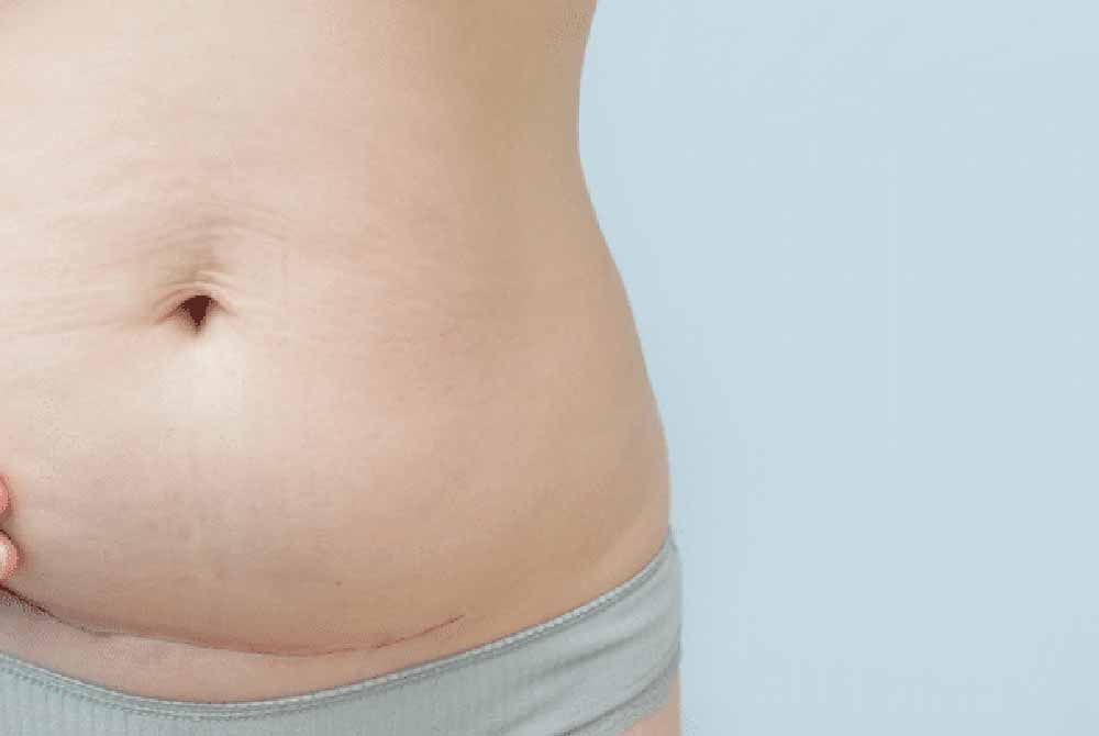Preparing for a cesarean section: What to expect and recovery tips