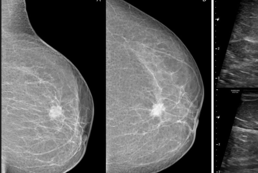 The Effective Combination of Mammography and Ultrasound for Preop Staging