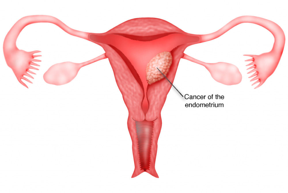 Thickened Endometrium and Cancer: Treatment Options and Considerations