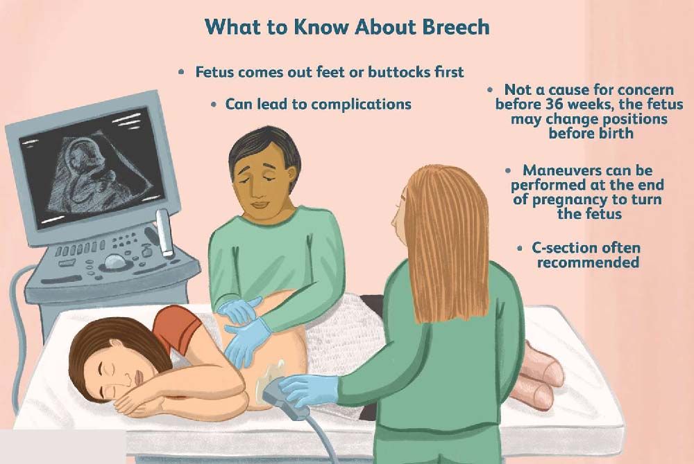 Understanding breech deliveries: Risks, options, and considerations