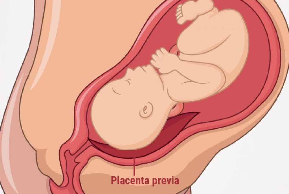 Understanding placenta previa: Risks, symptoms, and management