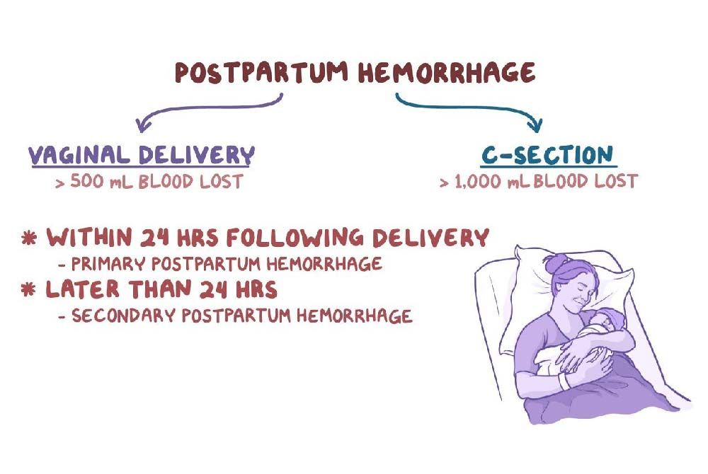 Understanding postpartum hemorrhage: Prevention and treatment