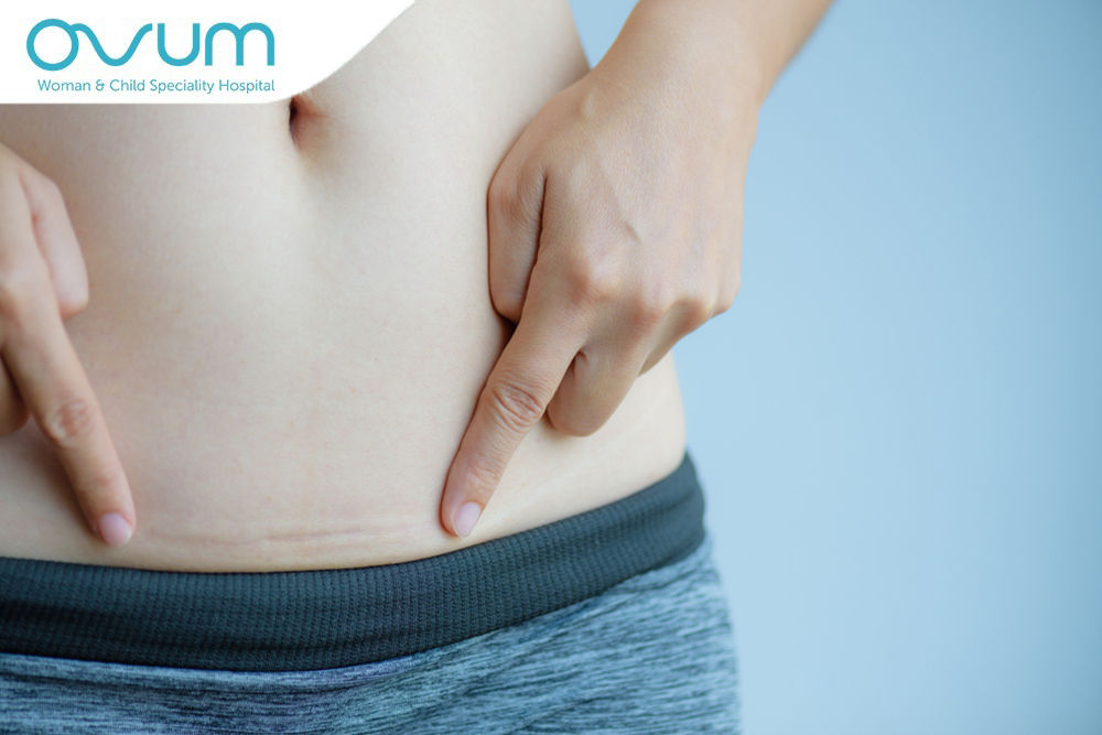 VBAC After C-Sections: Is It Possible?