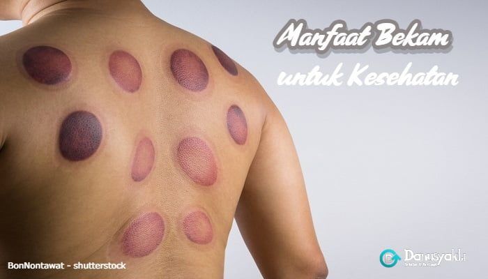 10 Manfaat Bekam untuk Kesehatan dan Menangkal Penyakit