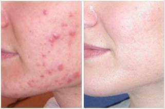 photodynamic therapy acne cost