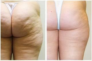 Look No Further for Fat or Cellulite Removal Treatment