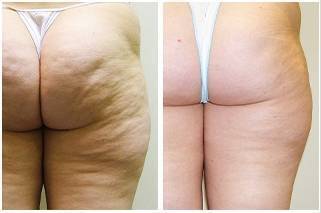 CoolSculpting Thighs in Dallas, TX: Sculpt your Ideal Legs