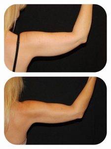 Emsculpt + CoolSculpt combo treatment for arms before and after