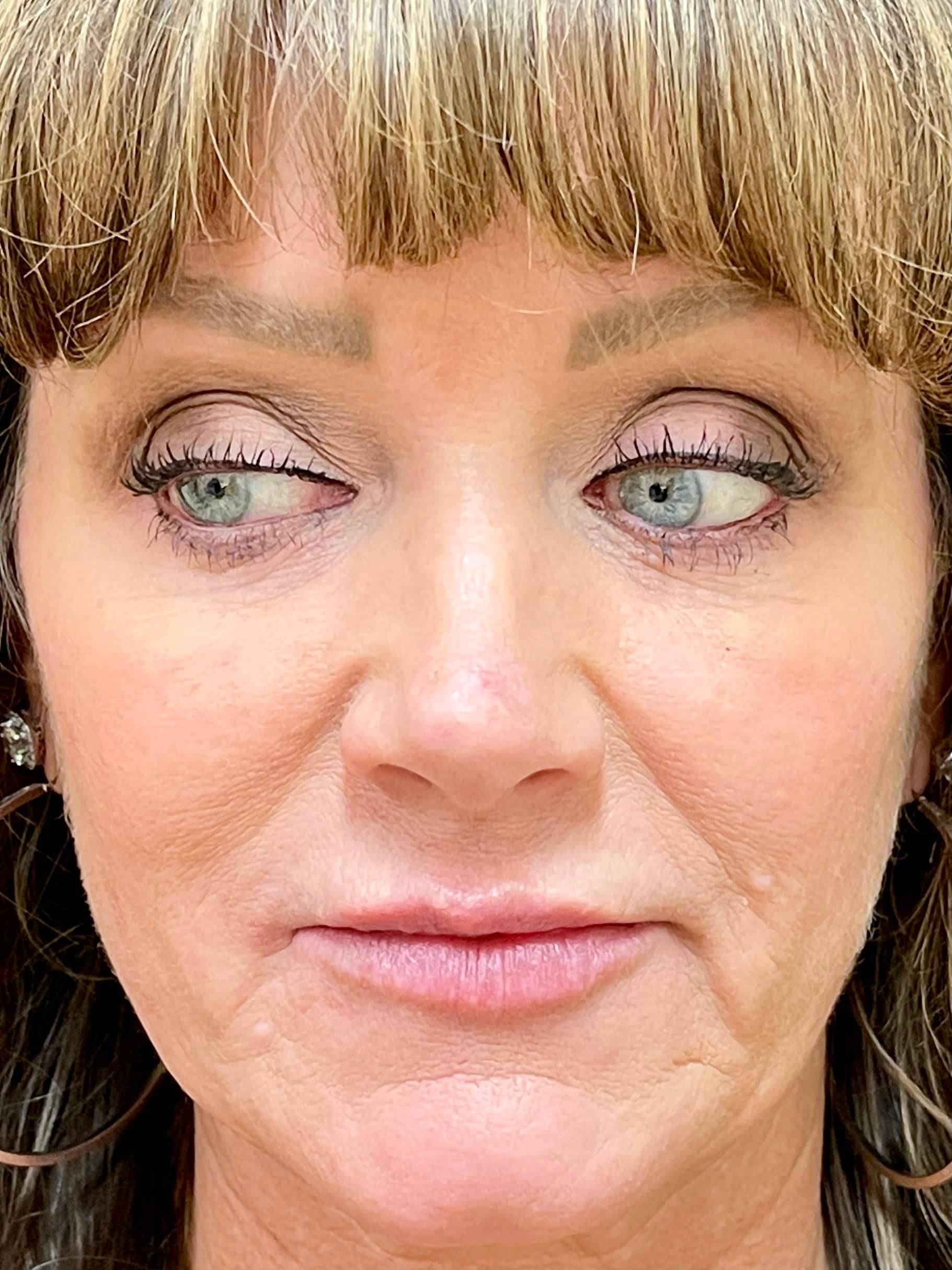 PDO ThreadLift Treatments in Dallas Advanced Skin Fitness