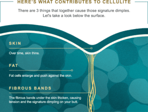 What contributes to cellulite