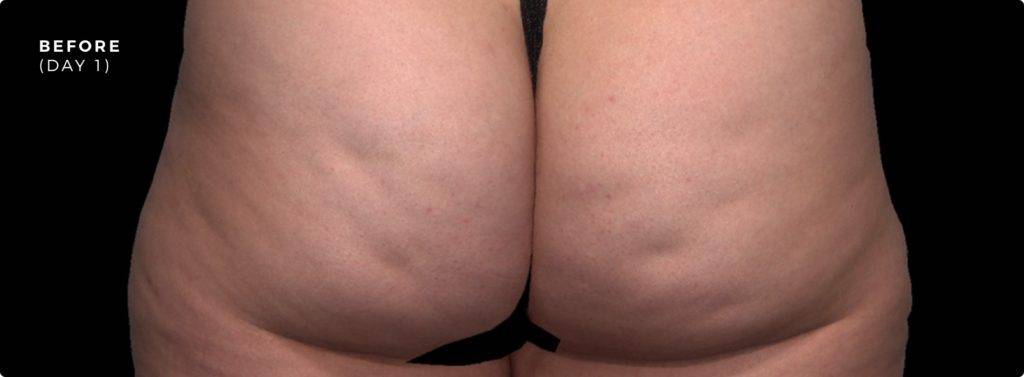 QWO Cellulite Reduction in Arlington TX