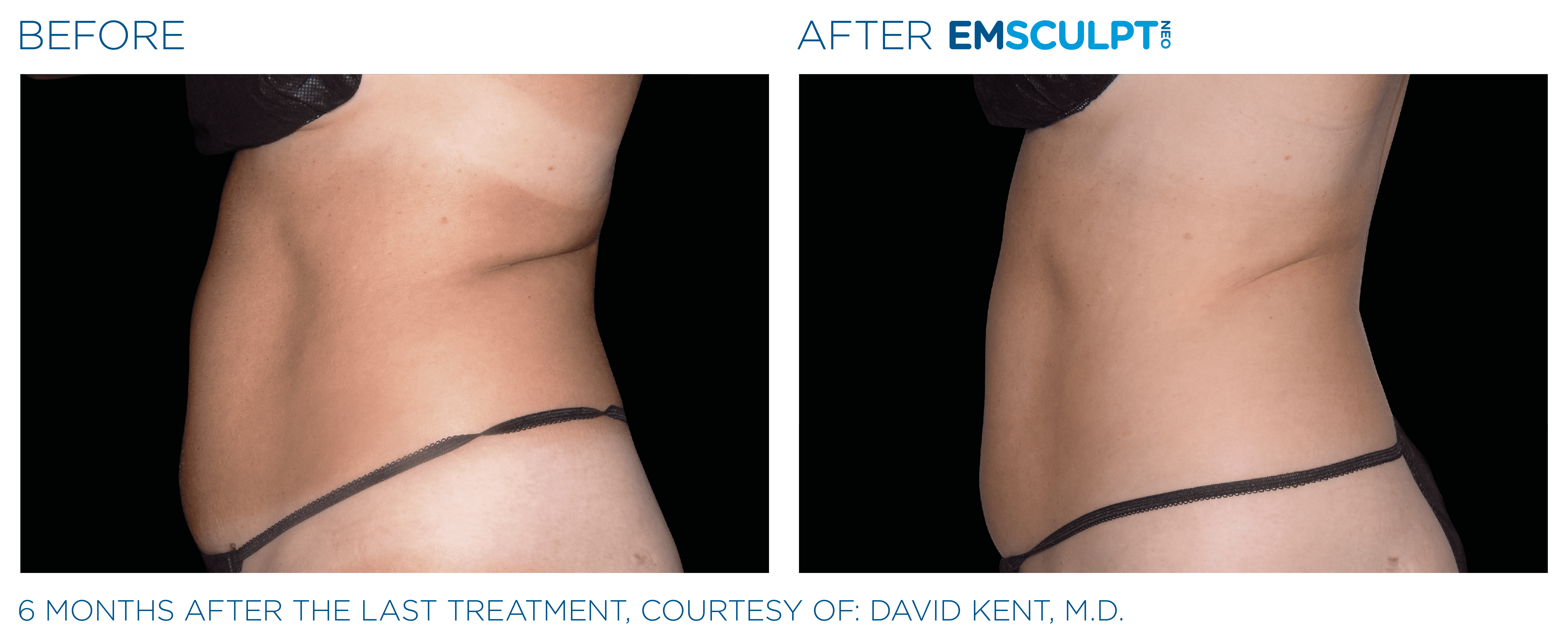 CoolSculpting Thighs in Dallas, TX: Sculpt your Ideal Legs