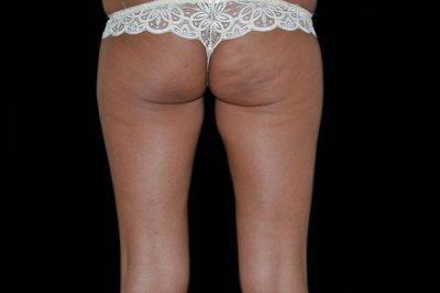 Dallas-Exilis_Ultra_PIC_004-Before-buttocks-female