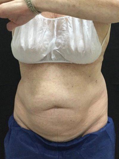 Fat reduction procedures - CoolSculpting, Dallas - Patient Example Before - Advanced Skin Fitness