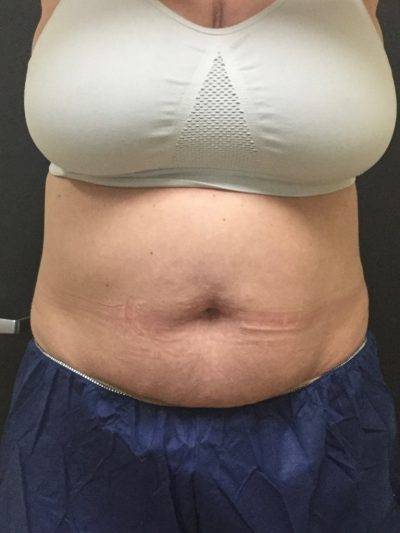 Fat reduction procedures - CoolSculpting, Dallas - Patient Example After - Advanced Skin Fitness