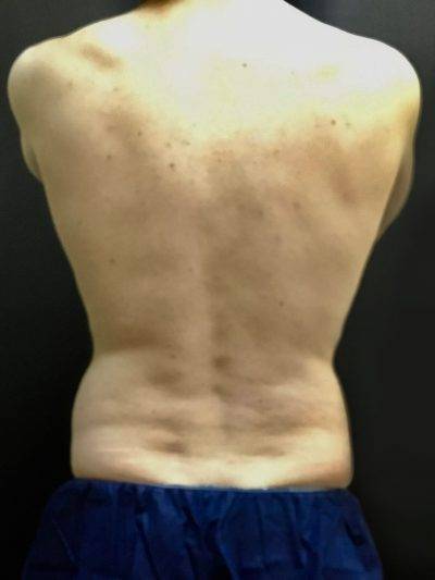 coolsculpting flanks before