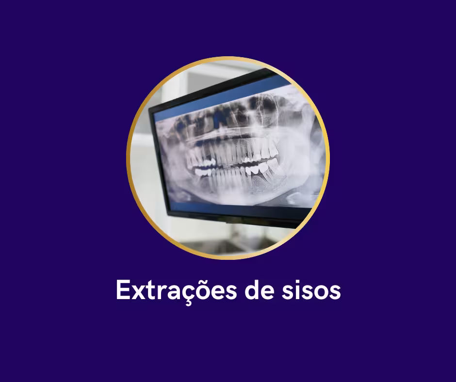 Extrações de sisos