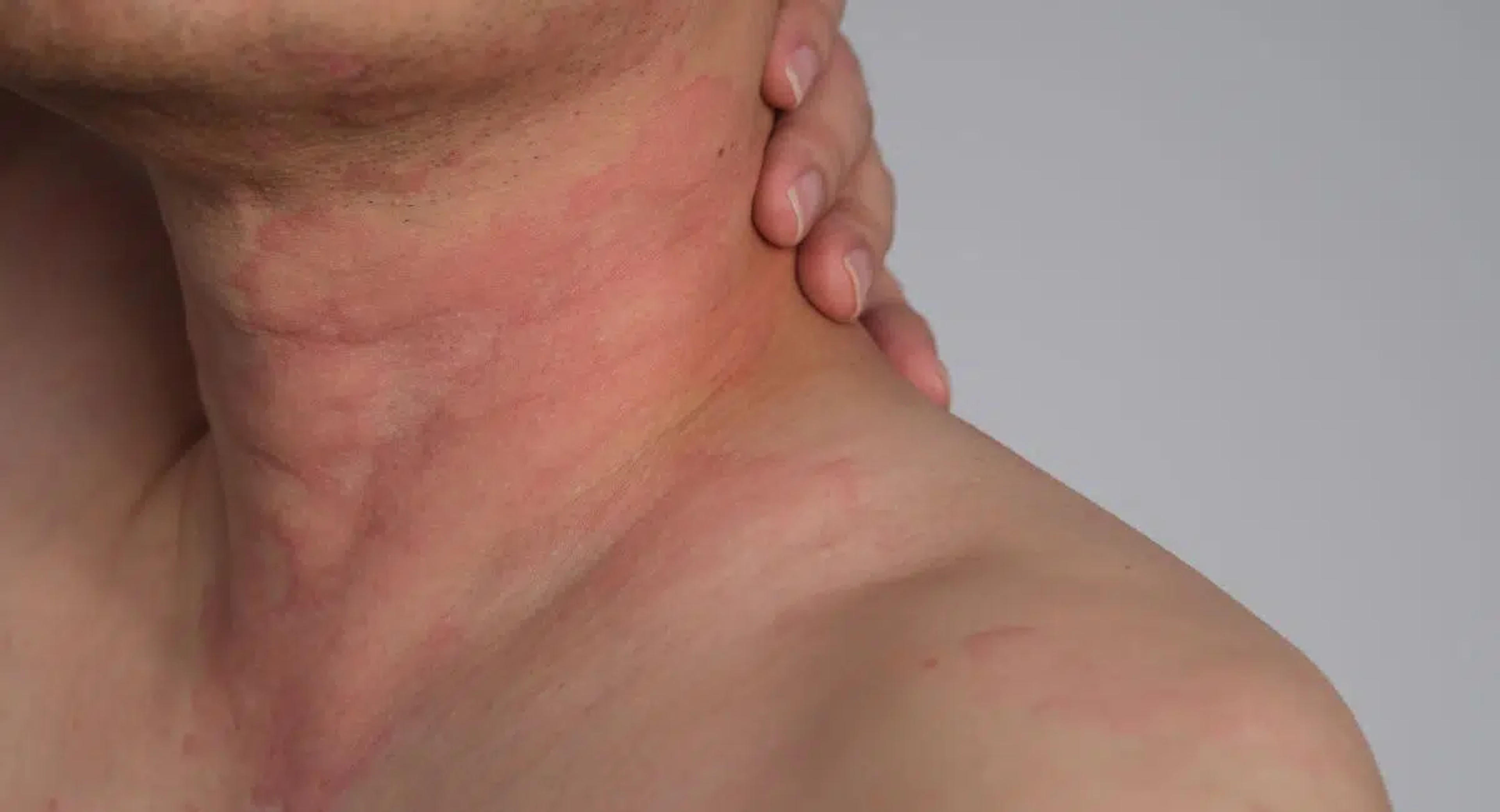 Skin reaction — redness and inflammation on neck