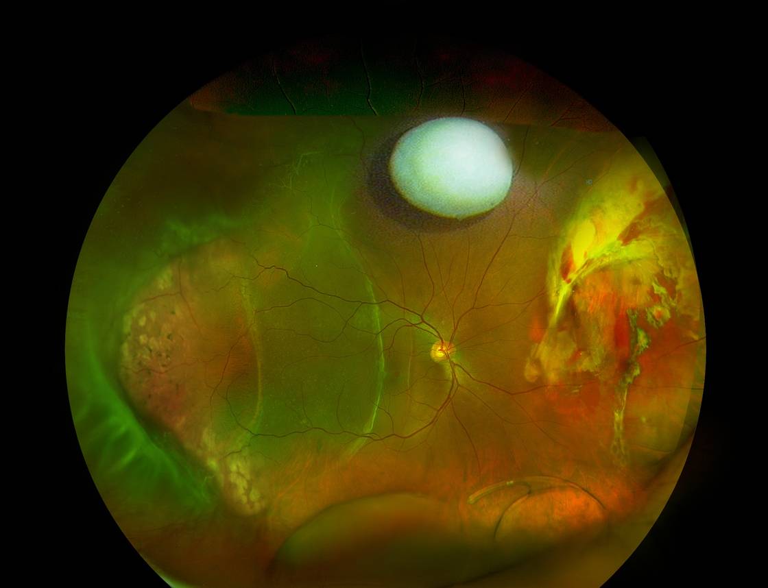 Retina Summit 008