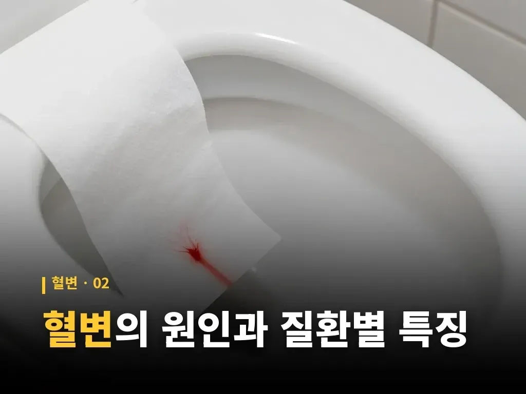 소아 혈변의 원인과 진료 이미지