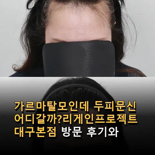 정수리탈모인데 두피문신은 어디가 좋을까? 리게인프로젝트 대구본점 방문 후기와 시술 정보