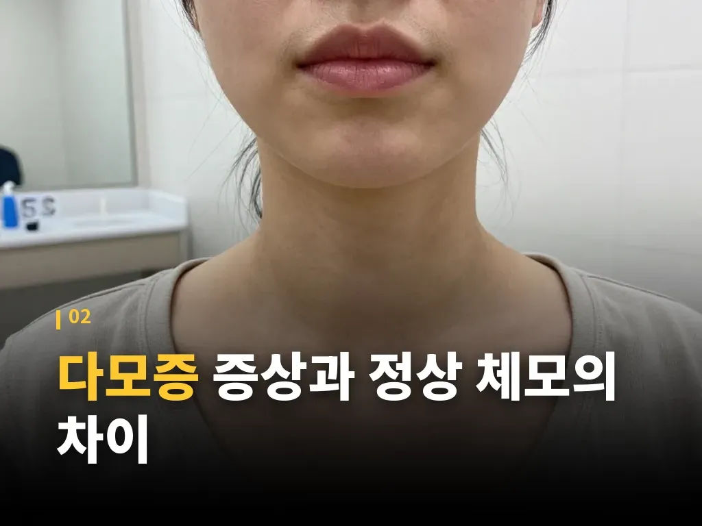 다모증 관리 방법과 치료 선택 이미지