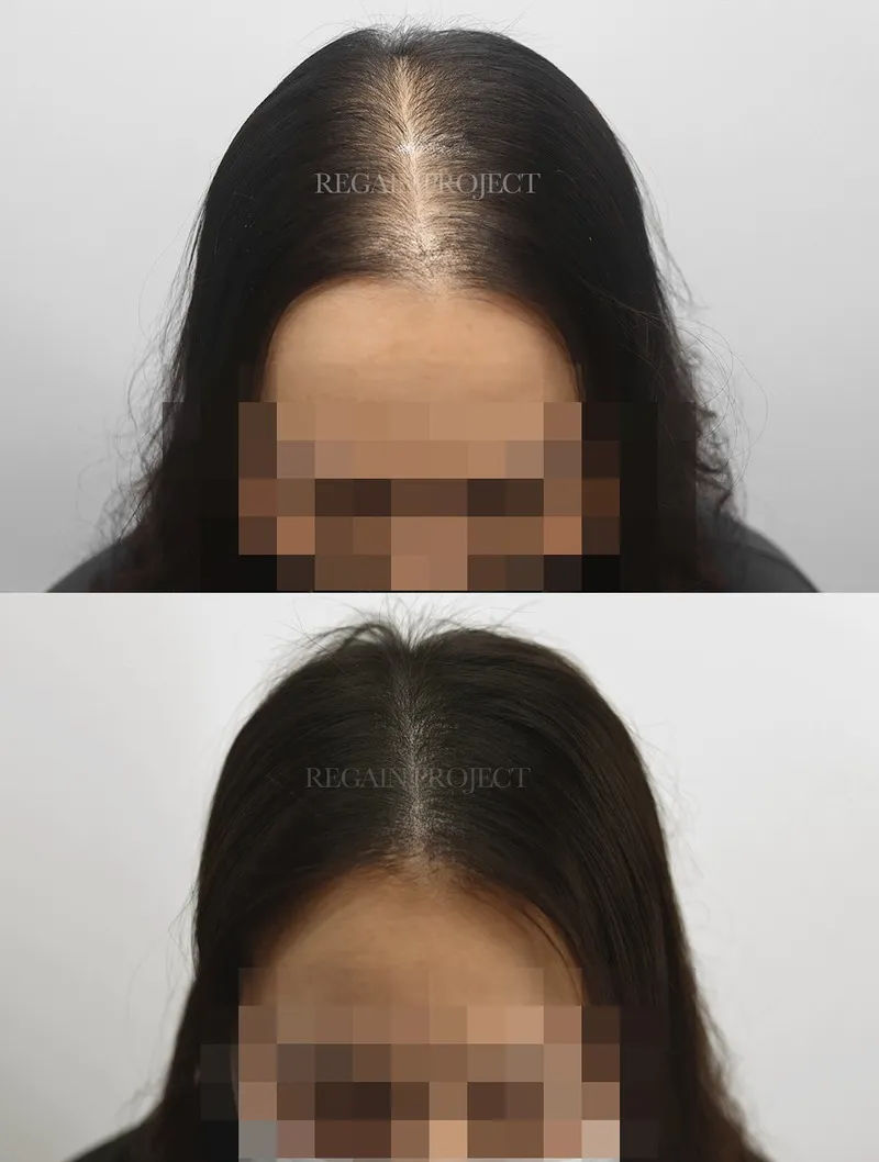 대구밀도보강 어디서 받지?어디가 잘하지? 리게인프로젝트 대구본점 Q&A 이미지
