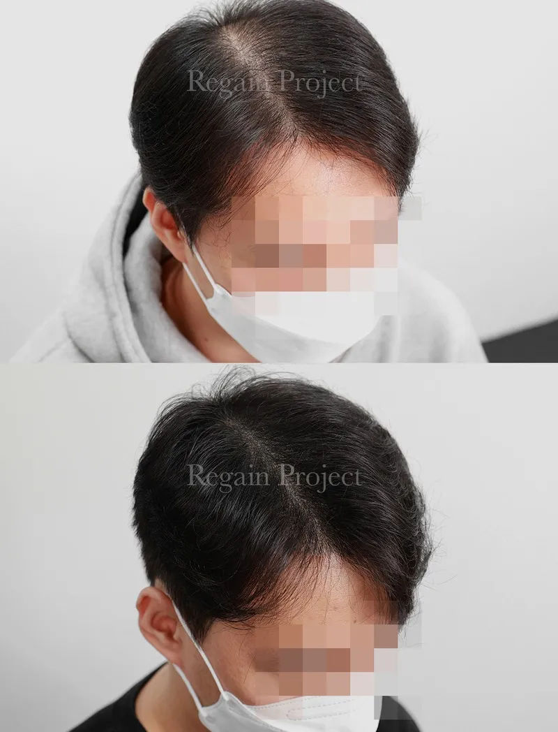 리게인프로젝트 시술 후기와 고객 만족도 이미지