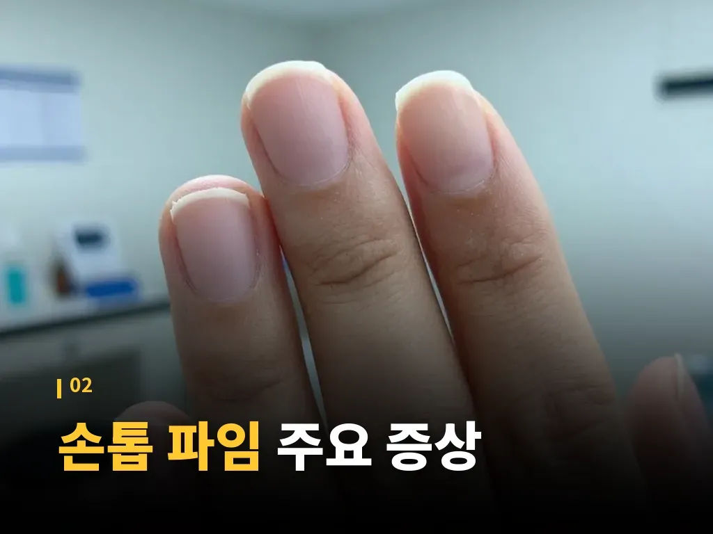 손톱 파임 해결 방법 이미지