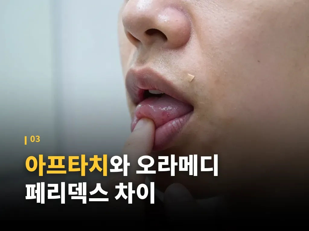 구내염 관리에 함께 챙길 생활 습관 이미지