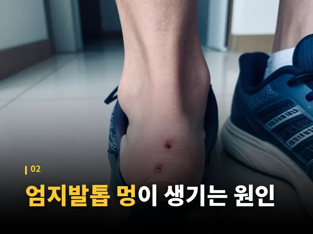 엄지발톱 멍 예방에 도움이 되는 습관 이미지