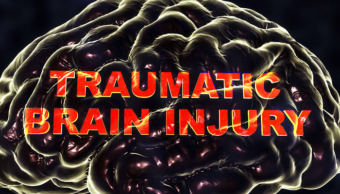 Understanding Mild Traumatic Brain Injuries