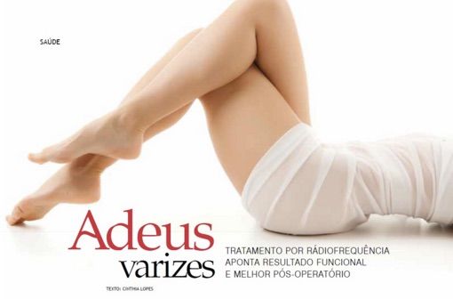 Varizes o que fazer Revista Glam