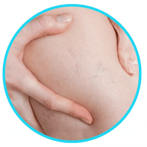 Assista a realização de escleroterapia de microvarizes com a utilização de espuma.