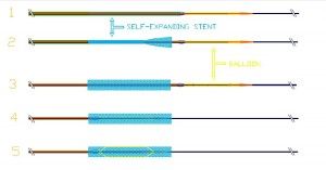 Stent auto-expansível com balão distal