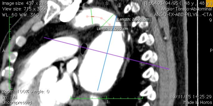 Doença Aneurismática da Aorta