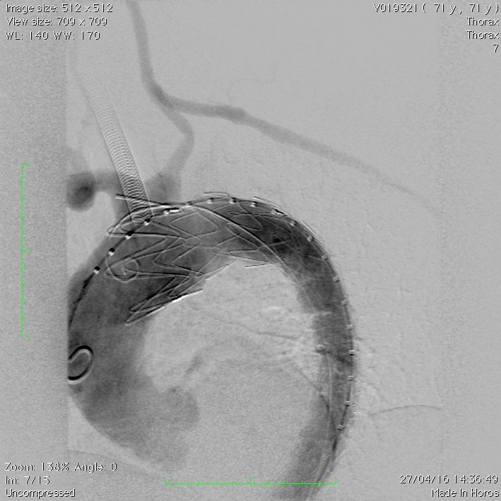 Tratamento endovascular de dissecção